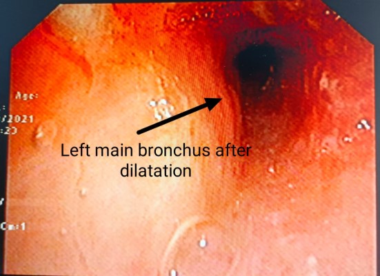 Bronchus After Removal