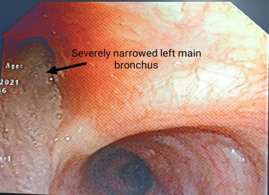 Severely Narrowed Bronchus